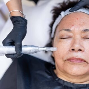 Microneedling Package of 4 Treatments