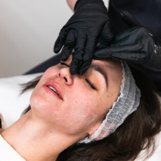KB Pure Advanced Peels Package of 4 Treatments
